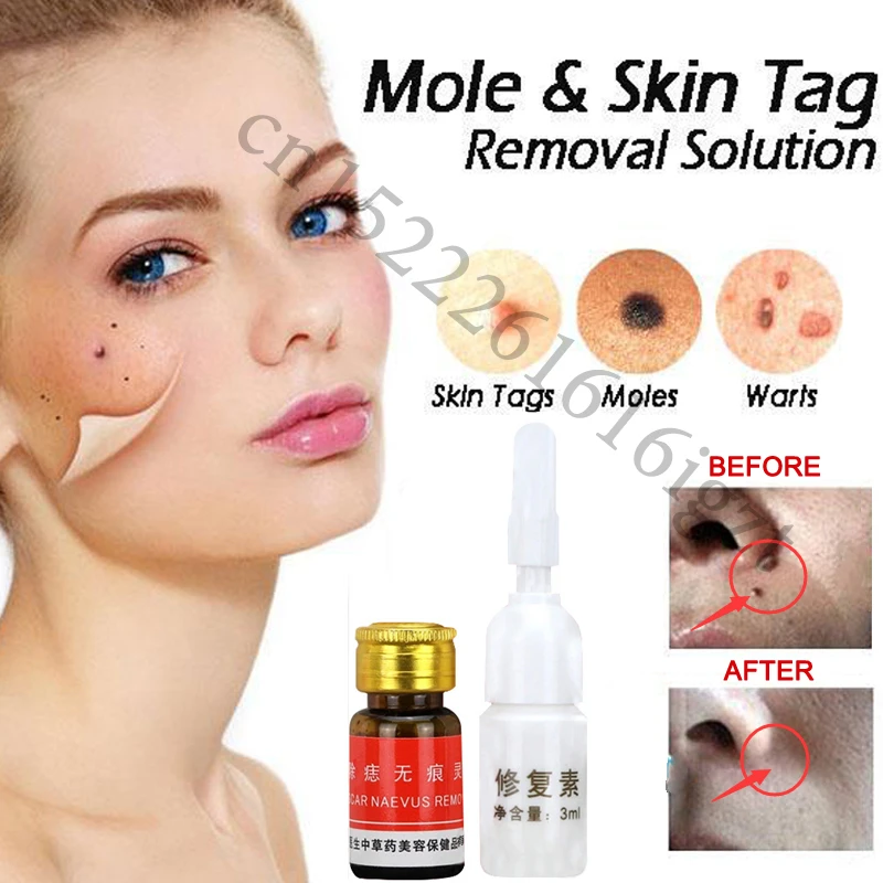 Mole Skin Tag Removal Solution Painless Mole Skin Dark Spot Removal Face Wart Tag Freckle Removal Cream Oil Plaster Patches Aliexpress