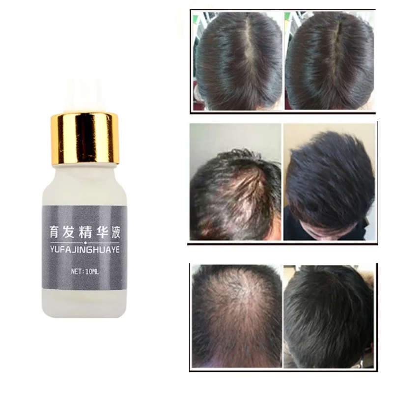 10ml Fast Powerful Nourish Hair Growth Products Regrowth Essence Preventing Hair Loss Liquid Treatment Hair Care dropship