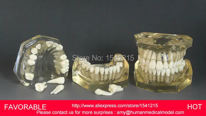 

TOOTH CARIES MODEL,ORAL TRAINING MODEL,DENTAL CAST MODEL ,REMOVABLE TRANSPARENT DENTAL MODEL DENTITION-GASEN-DEN039