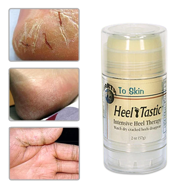 cream for cracked skin