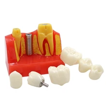 Dental Implant Four Times Teaching Teeth Model 4 Times Dental Resin Quartz Rubber Teeth Model Dentist Training Pathology Model