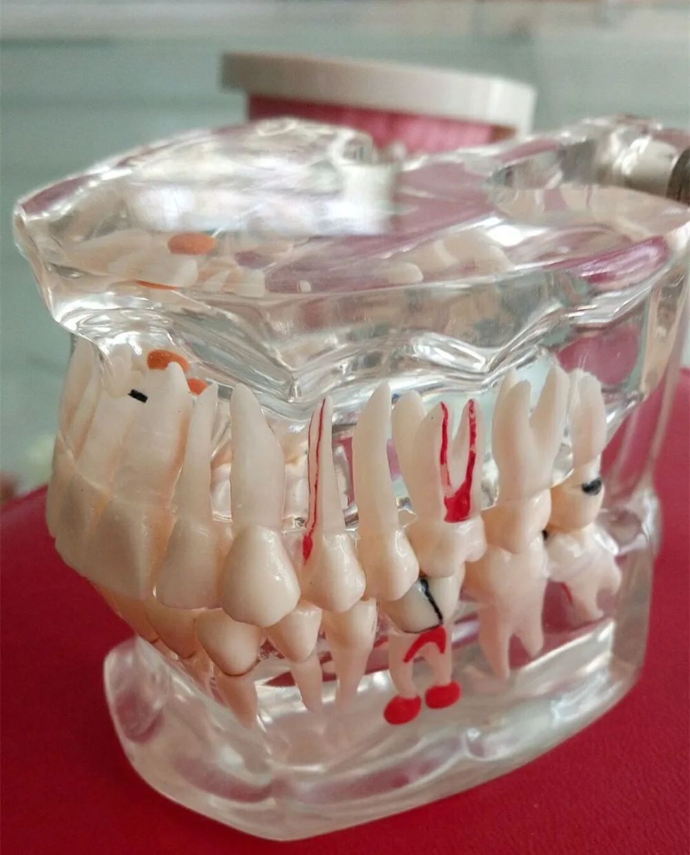 

dental pathology study model,education model,Removable ,dental clinic material