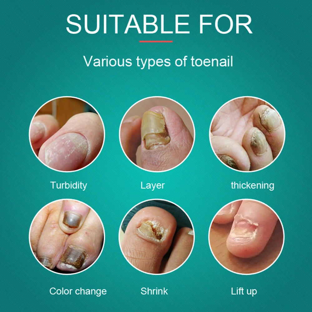 TYJR Nail Repair Care Fungal Nail Treatment 10ML/Bottle Nail Fungus Oil Onychomycosis Liquid Nourishing Oil