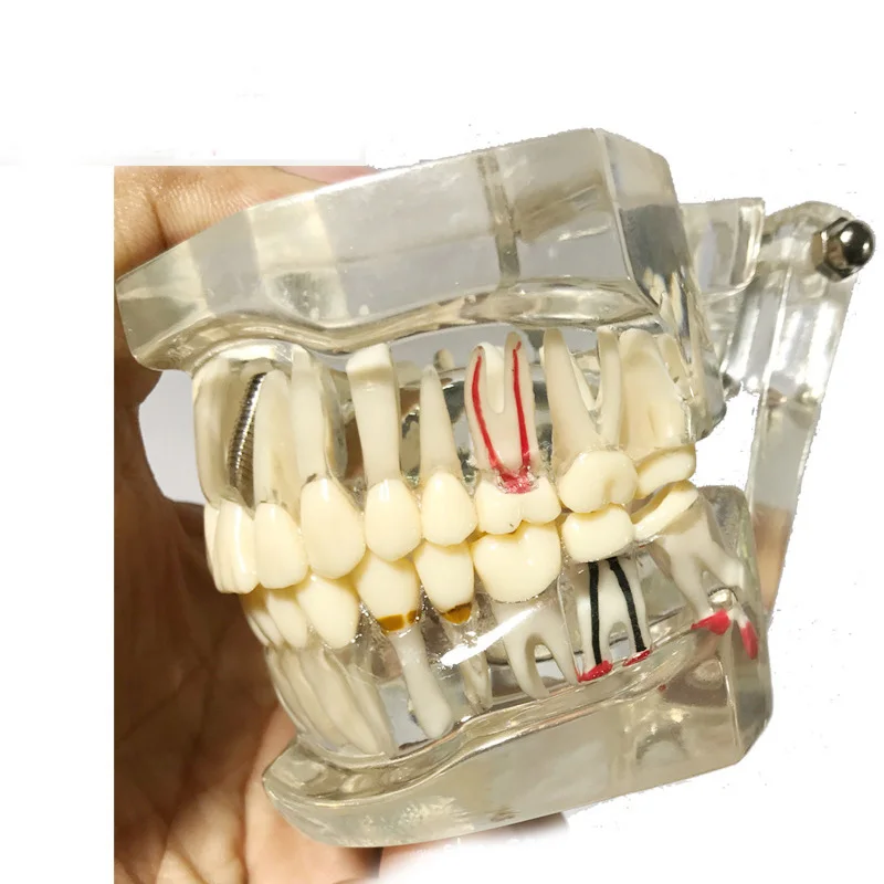 Dental Study Tooth Transparent Adult Pathological & Disease Teeth Model