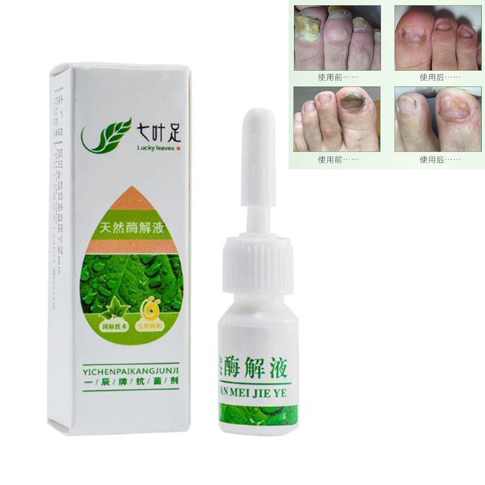 Nail Fungus Treatment Onychomycosis Paronychia Anti Fungal Nail Infection Good Result Chinese Herbal Toe Nail Plaster