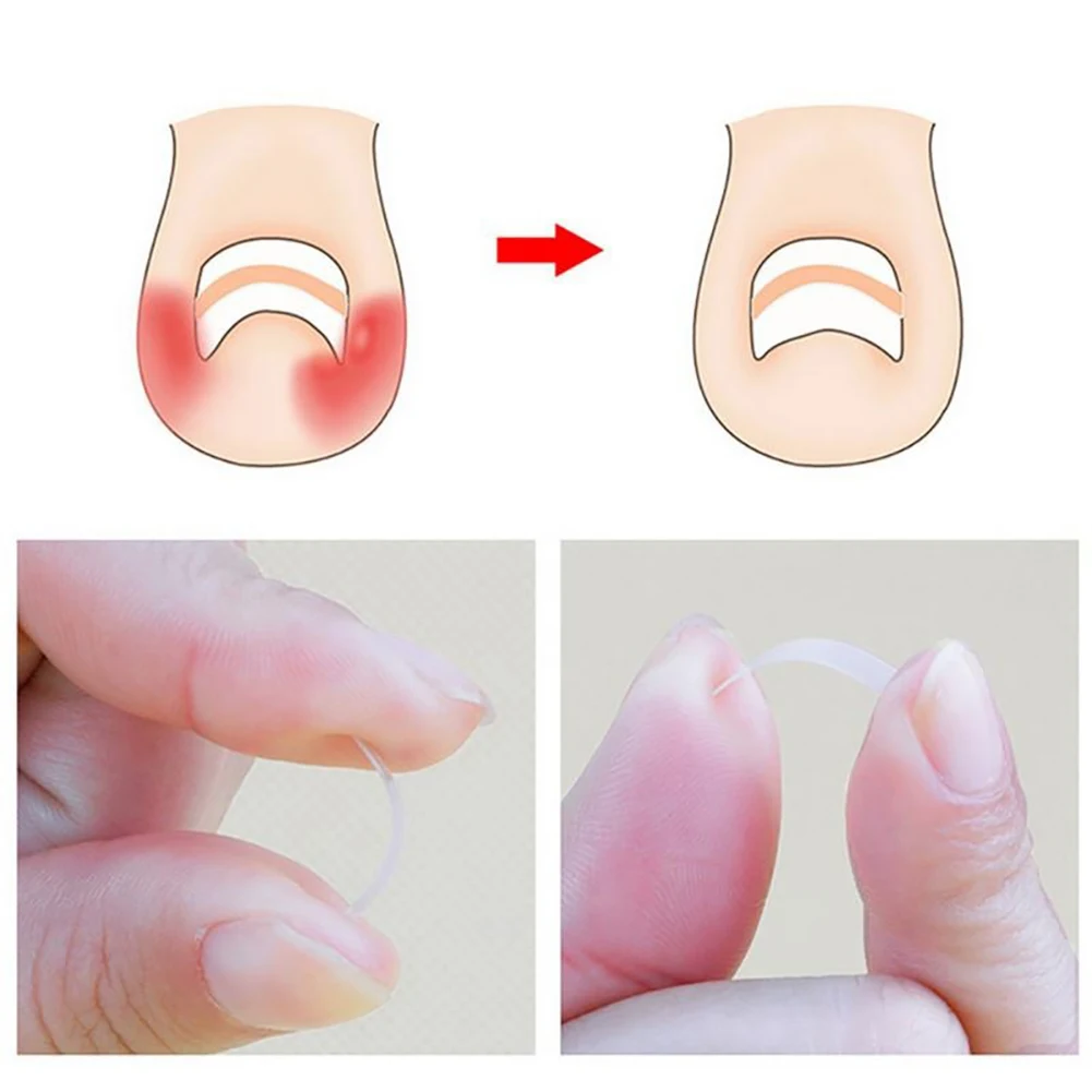 GUJHUI 10Pcs/Box Ingrown Toe Nail Correction Sticker Paronychia Foot Care Treatment
