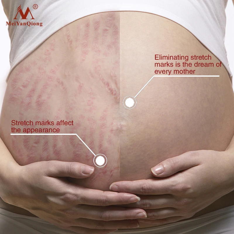 High-Quality-Smooth-Skin-Cream-For-Stretch-Marks-Scar-Removal-To-Maternity-Skin-Repair-Body-Cream