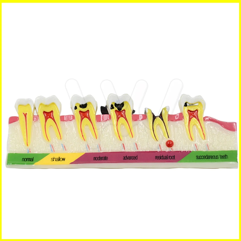 Dental-Caries-Developing-illusteation-Tooth-Model-Demonstration-Teach