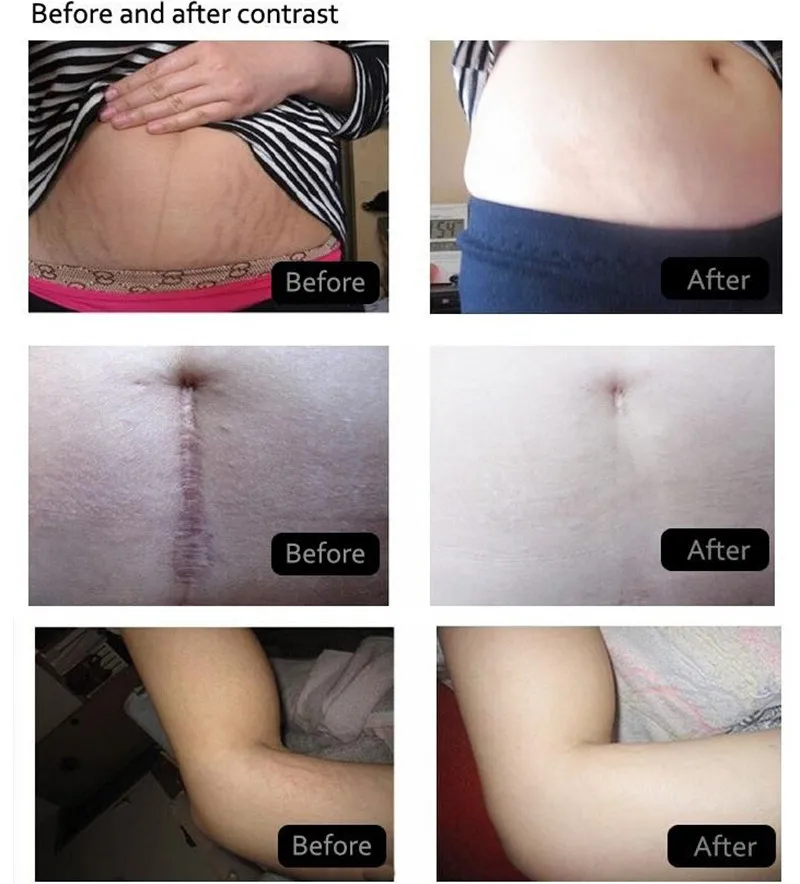 MeiYanQiong Pigmentation Corrector Skin Cream For Stretch Marks Scar Removal To Maternity Skin Repair Body Cream