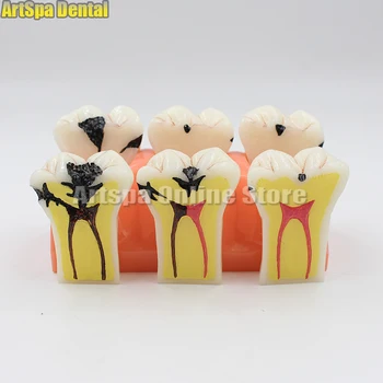 

1PCS 4X Denture Disease Teeth Model Caries Decomposition Decay Tooth Model For Dental Medical Demo Communication Teaching