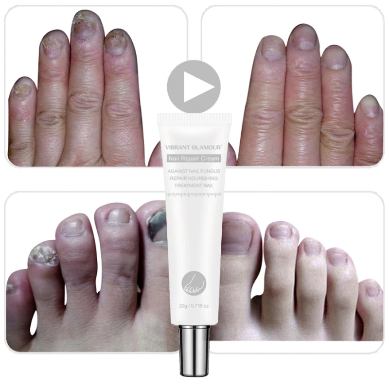 Яркий гламурный 20 г грибок ногтей ремонт крем лечение Onychomycosis удаление противогрибковый крем для ног Уход за ногтями TSLM1