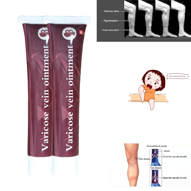 

2PCS Varicose Veins Treatment Ointment Vasculitis Phlebitis Angiitis Inflammation Blood vessel Rotten legs Varicose Veins Cream