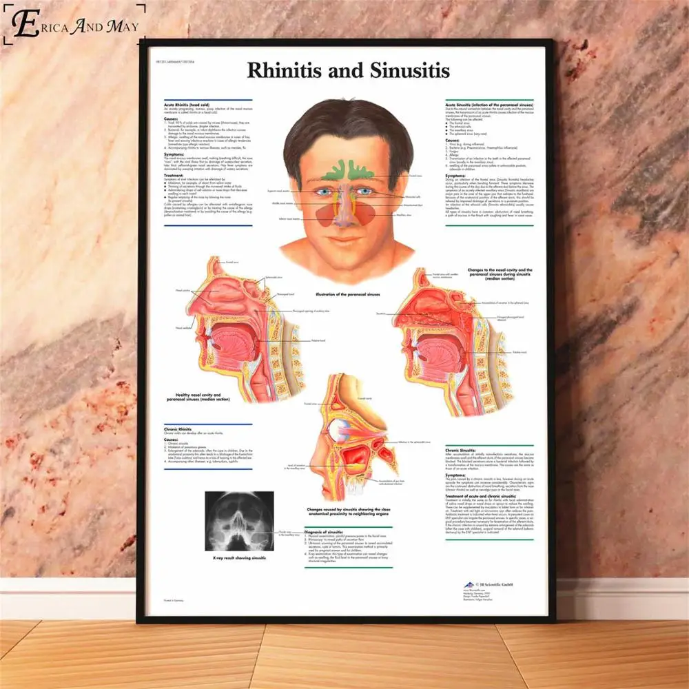 Анатомия болезни патологии диаграмма картина, печатный плакат декоративные настенные картины для комнаты без рамки украшения дома аксессуары - Цвет: Rhinitis Sinusitis