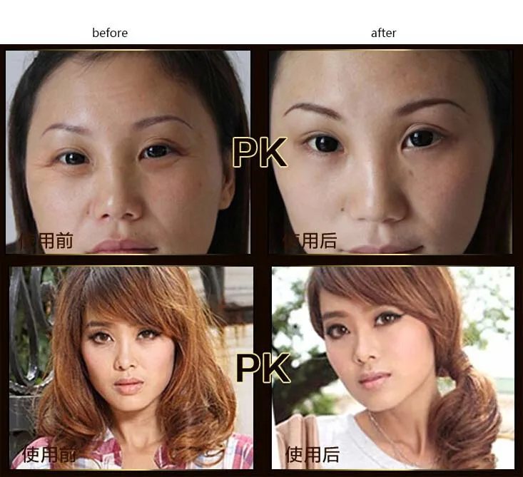 korean under eye bags treatment