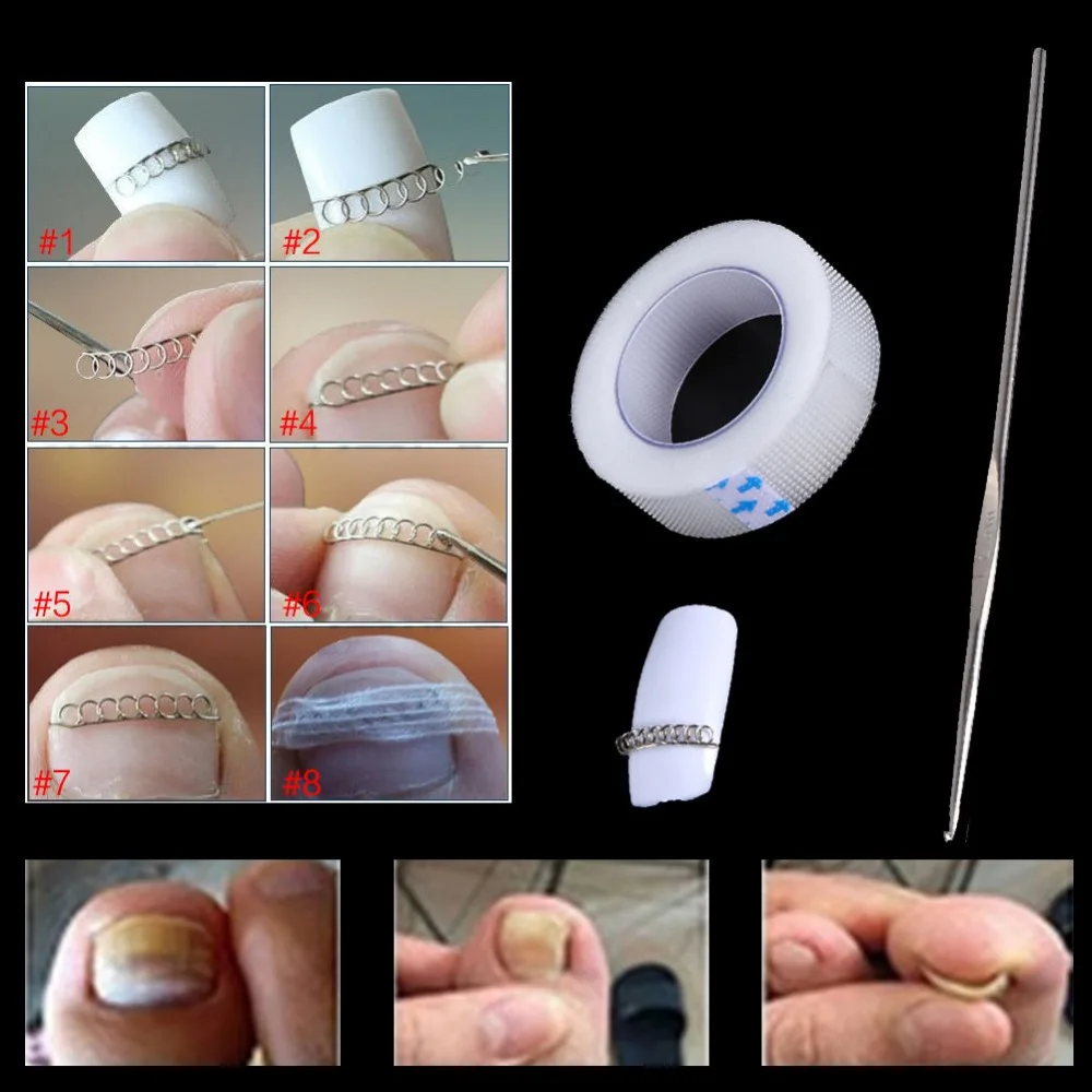 3Pcs/Lot Ingrown Toe Nail Correction Wire Fixer Pedicure Recover Paronychia Acronyx Bunion Corrector Foot Care Tools #255595