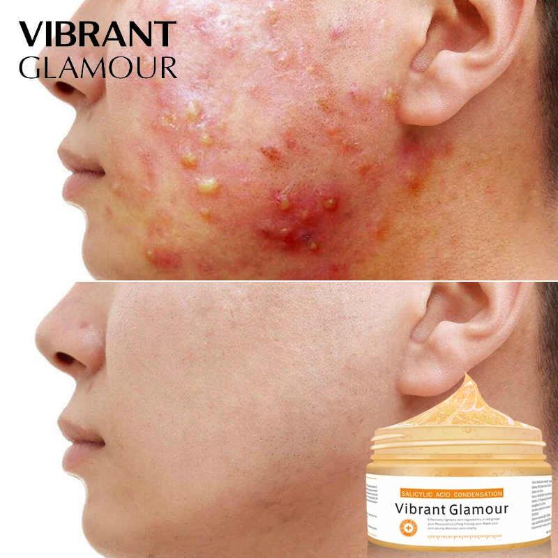 

VIBRANT GLAMOUR Salicylic Acid Condensation Face Mask Skin Care Remove Acne Treatment Oil Control Pigmentation Corrector Cream