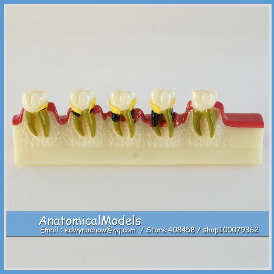 

13154 DH1308 Human Teeth Peridontal Diseases Developing Model , Medical Science Educational Dental Teaching Models
