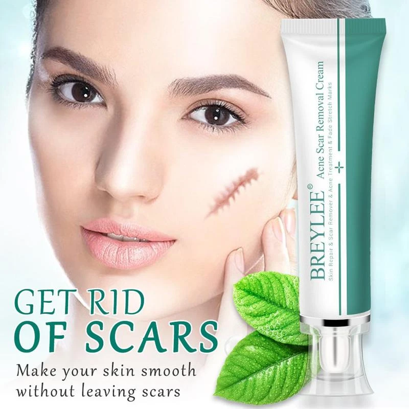 face cream to get rid of acne scars