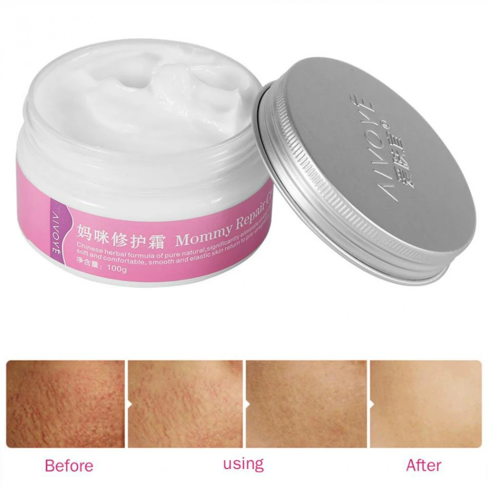 Mom Comfort (cream from stretch marks): customer feedback. How effective is Moms Comfort Cream Mom Comfort (cream from stretch marks): customer feedback. How effective is Moms Comfort Cream