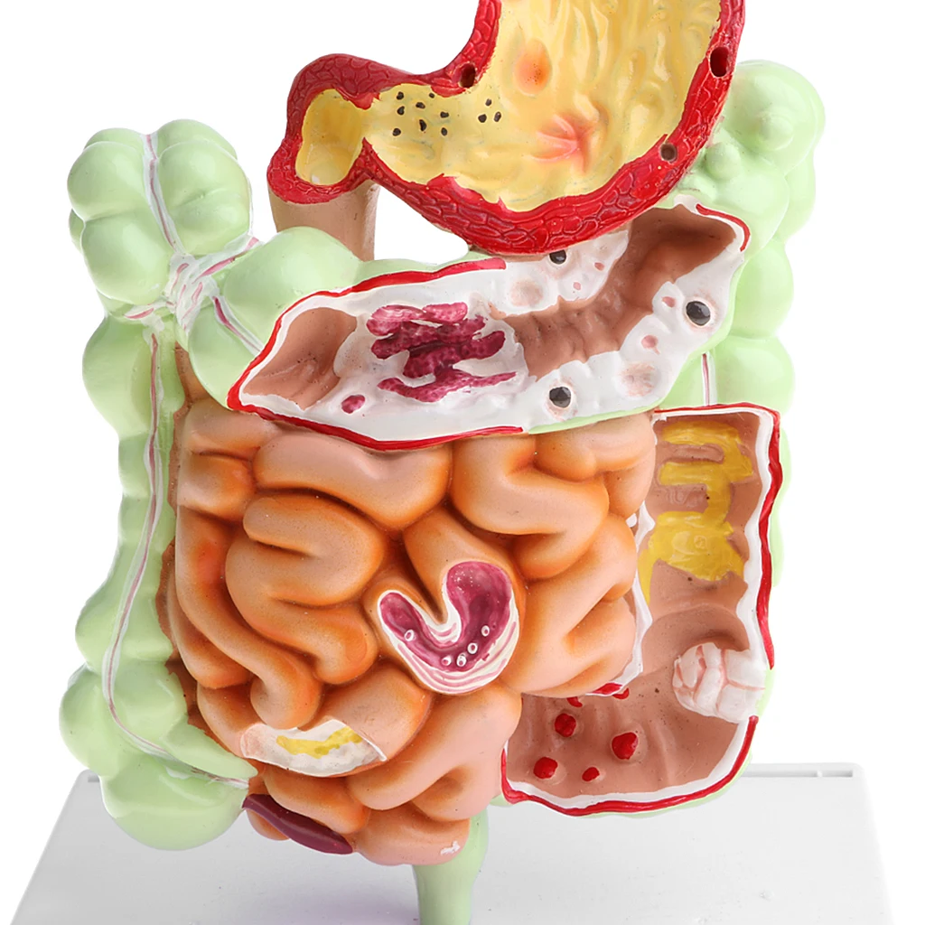 Minify 1X Human Large Intestine Stomach Pathological Model Medical Teaching Lab Demonstration Supplies