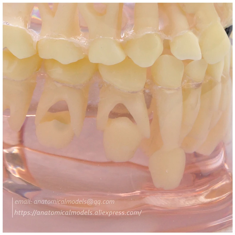 13062 Clear Mixed Age model with Caries 2 