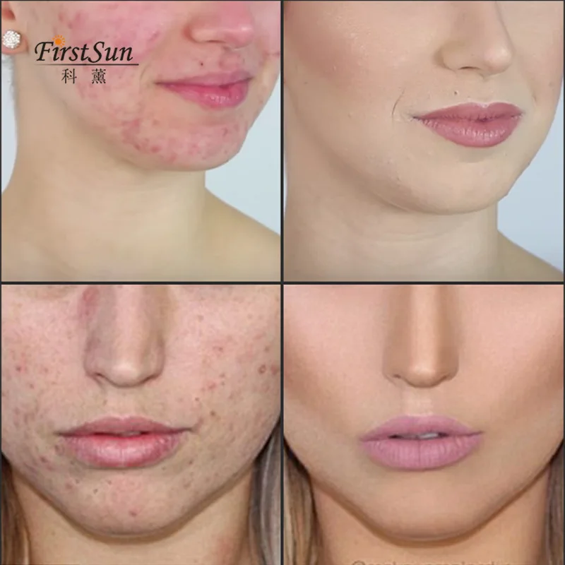 Firstsun 100% الشاي شجرة مجمع زيت طبيعي علاج حب الشباب العناية بالوجه الجلد النفط تحكم البثرة مزيل مكافحة ندبة البقع الجمال