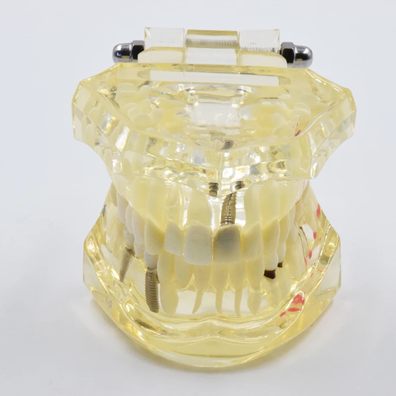 

OSLDent Dental Yellow Implant Disease Teeth Model with Restoration Bridge Tooth Dentist for Medical Science Teaching Adult Resin