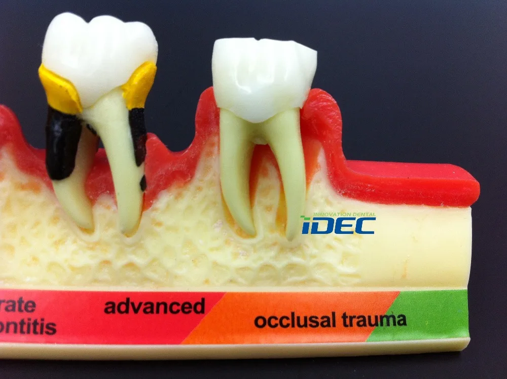Стоматологическая модель зубов пародонтальная болезнь Assort зуб классификация модель 1 шт