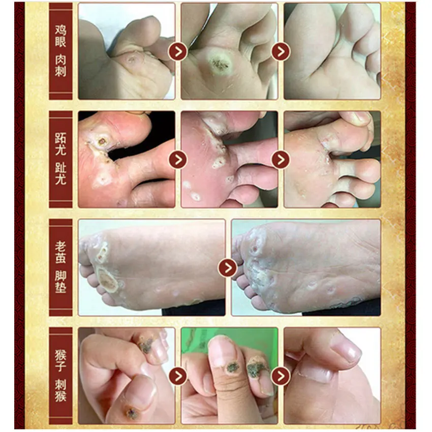 Лечение китайской медициной удаления кукурузы для ног Plantar Warts Pomada De Verruga Уход за