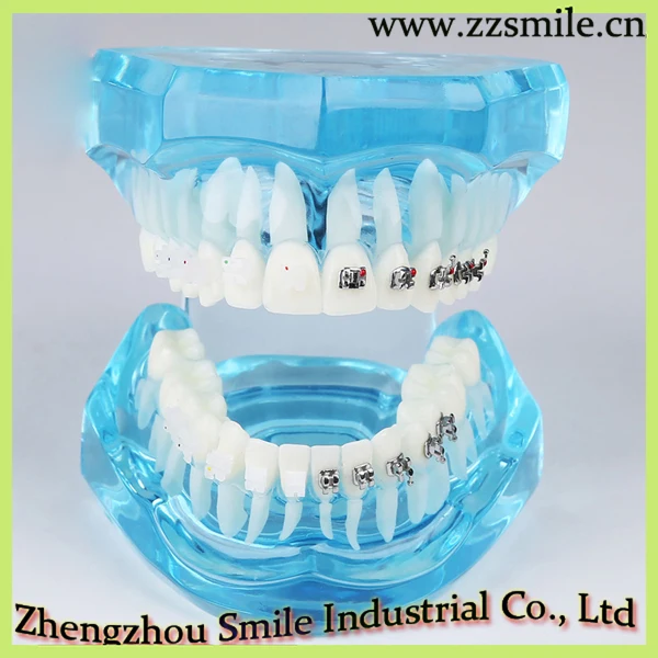 

Dental Study Model with Orthodontic Half Ceramic and Half Metal Bracket M3003