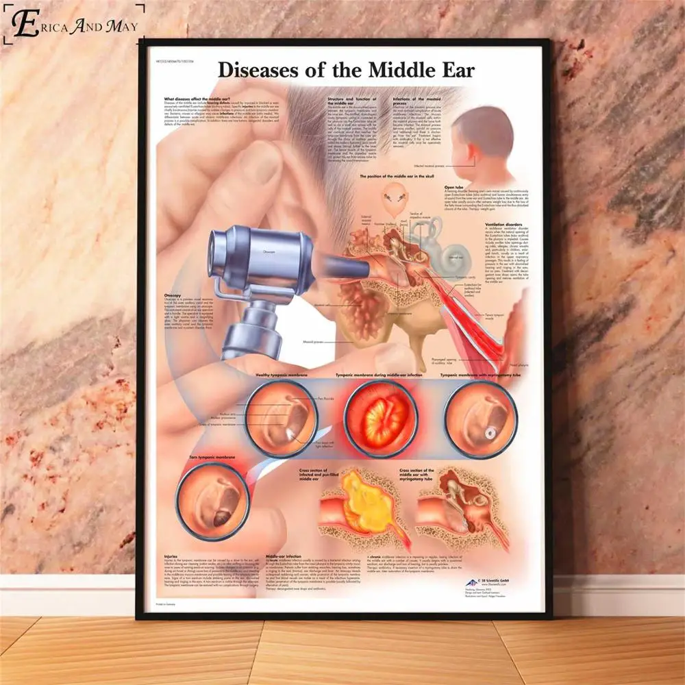 Анатомия болезни патологии диаграмма картина, печатный плакат декоративные настенные картины для комнаты без рамки украшения дома аксессуары - Цвет: Middle Eye Diseases