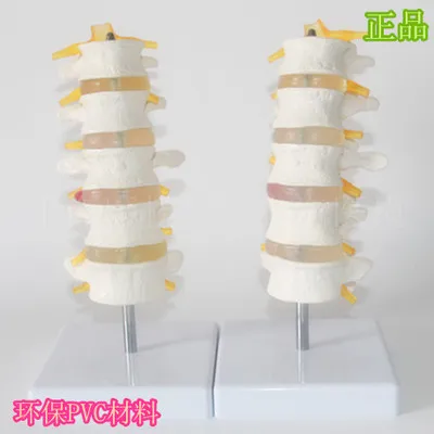 

human Lumbar spine model protrusion of intervertebral disc demo