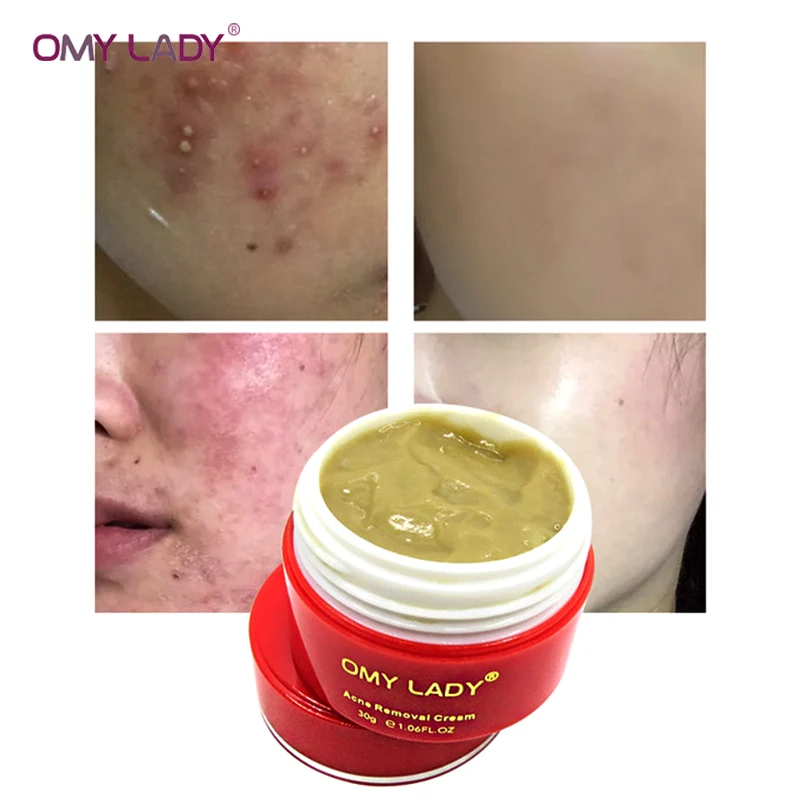 OMY LADY мощный мульти эффект экстракт крем устраняет морщины удаление акне шрам