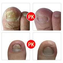 Средство для удаления грибковой инфекции ногтей, лечение грибка ног, уход за ногтями