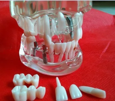 

Dental model tooth pathology Removable Dental Materials free shipping