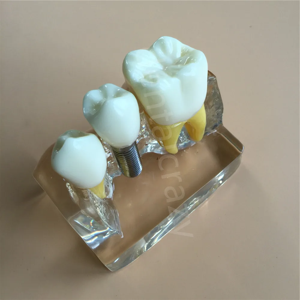 Чистая Стоматологическая демонстрационная модель зубов для анализа имплантатов Модель моста короны