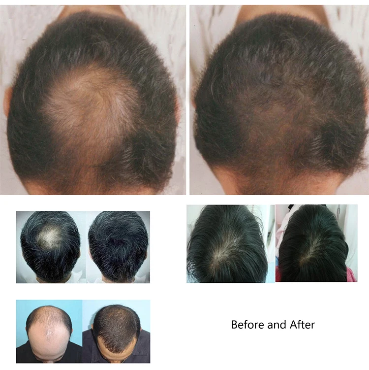 Hair Regrow Laser Helmet 38 Medical Diodes Treatment Hair Loss