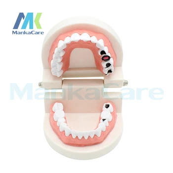 

Standard Tooth Teaching Giant Dental Dentist Teeth Model Child Kidtraining Model Disease Teeth Medical Typodont Demonstration