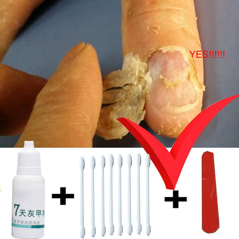 Toe Nail Fungus Treatment Anti Fungal Nail Infection Yellow Essence Removal Care Clear Fungus Nail Cure Treatment
