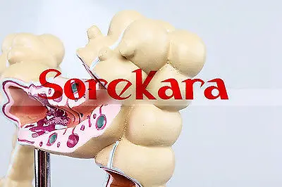 Людская анатомическая двоеточия полипа Рак язвы больные Органы Спецодежда