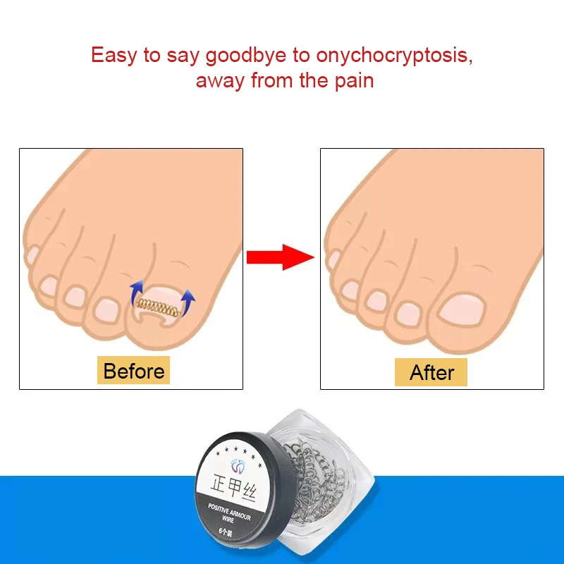 

6 Pairs/ box Toe Nail Corrector Paronychia Corrector Nail Care SK88