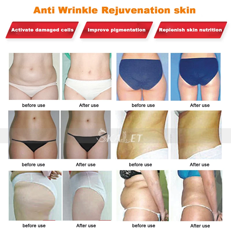 Endurecimento da Pele Cuidados com a Pele Remoção de Gordura Dispositivo da Beleza da Terapia Hottest Ultra-sônica Massagem Emagrecimento 1 Mhz 8 terapia da remoção da pele do emagrecimento da beleza