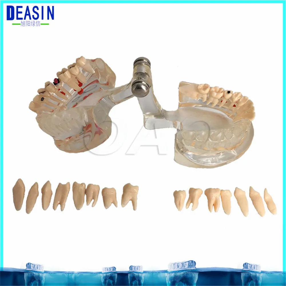 Dental Implant Teeth Half side can be removeble model Pathological Model Teaching& Restoration Bridge Tooth Dental Implant Teeth Half side can be removeble model Pathological Model Teaching& Restoration Bridge Tooth