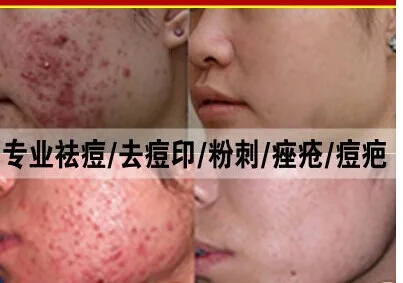 strong acne cream