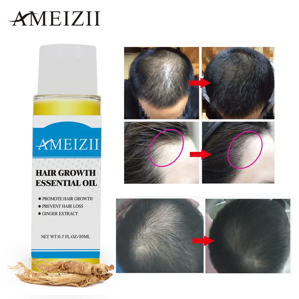 AMEIZII Hair Growth Essential Oil Products Organic Natural Ginger Extract Hair Loss Care Serum Dense Treatment Essence 20ML AMEIZII Hair Growth Essential Oil Products Organic Natural Ginger Extract Hair Loss Care Serum Dense Treatment Essence 20ML