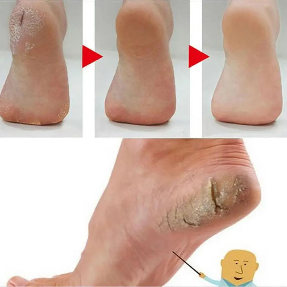 Китайский медицинский крем для ухода за кожей от трещин на ногах, против трещин на ногах, крем для ухода за кожей ног