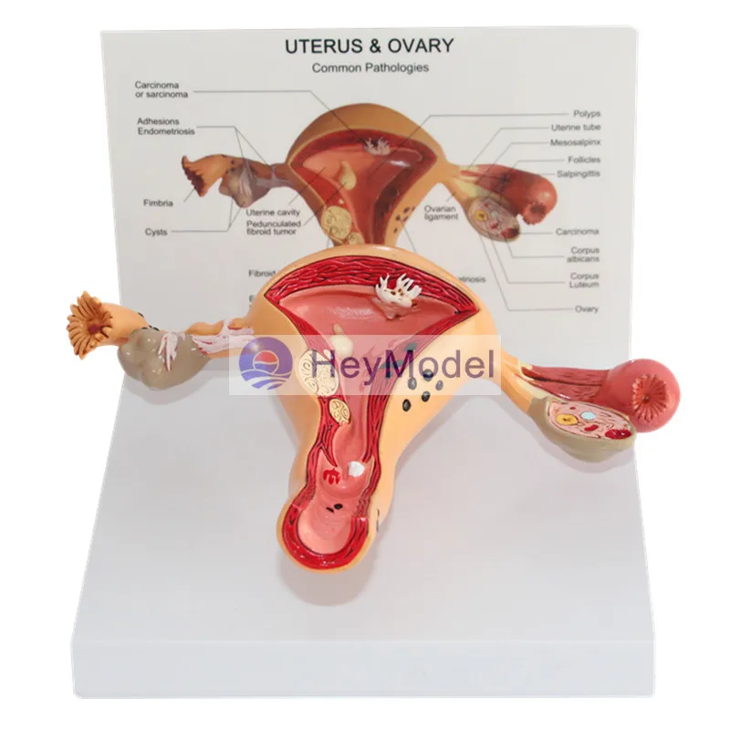 Heymodel женской матки яичников матки патологии модели