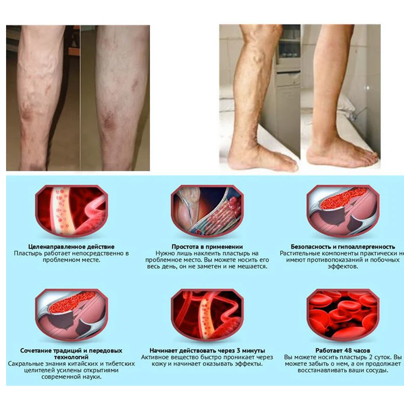 Chinese Traditional herbal medicine Patches Cure Spider Veins Varicose