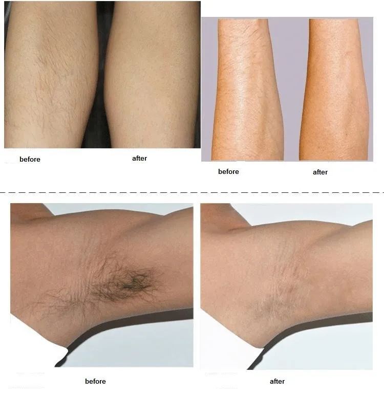 elos hair removal  19