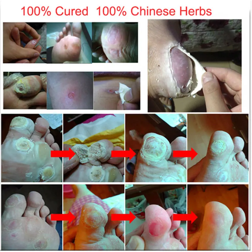 Лечение китайской медициной удаления кукурузы для ног Plantar Warts Pomada De Verruga Уход за